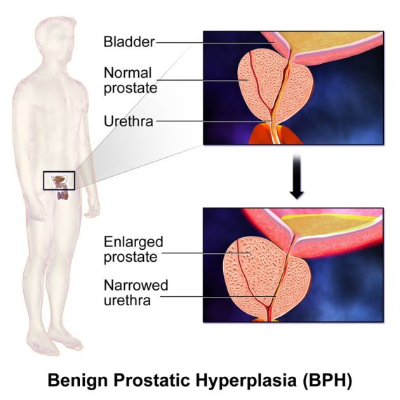 Schema dell’ipertrofia prostatica benigna con l’uretra compressa dalla prostata ingrossata