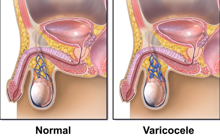 Schema del confronto fra il plesso pampiniforme normale e le vene dilatate del varicocele